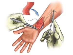 skin transplantation